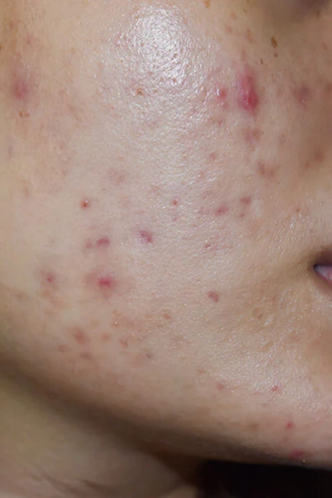 Clear Skin Revival Facial
