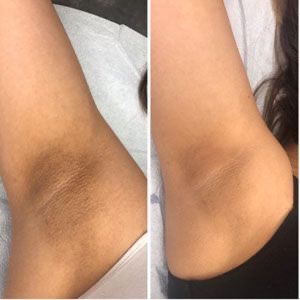 Armpit Bleaching