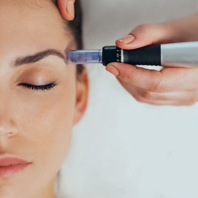 Microneedling treatment at The Glow & Care Spot in El Monte, CA