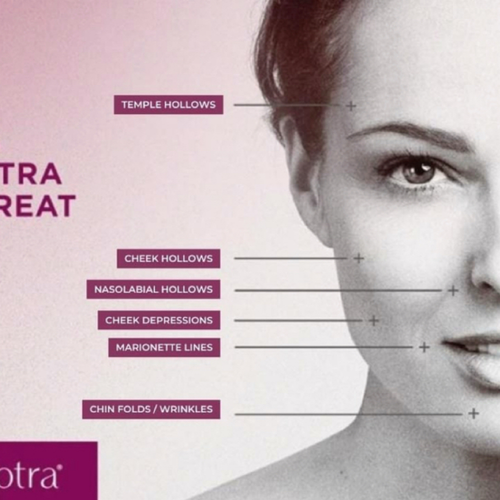 Sculptra Facial Balancing at Luxehaus aesthetics & wellness by Cynthia Lucio in Bolingbrook, IL