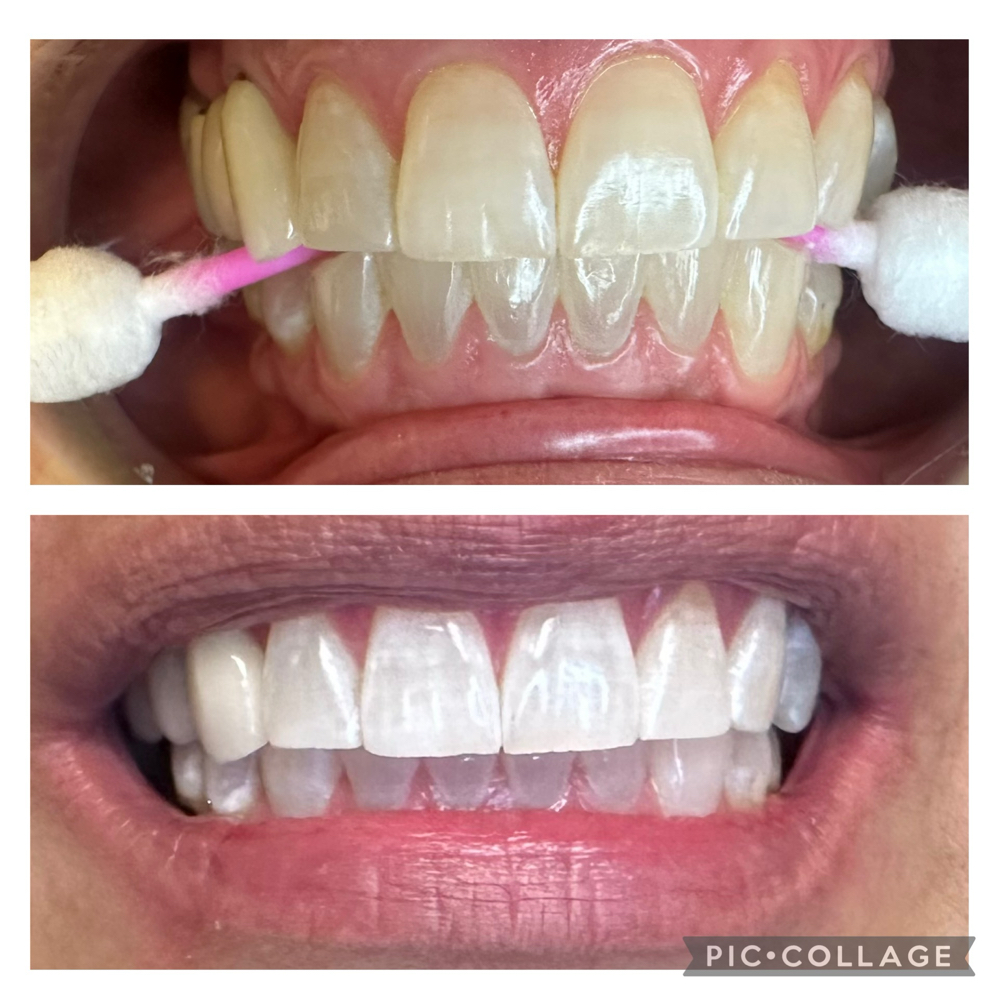 80 Minute Teeth Whitening
