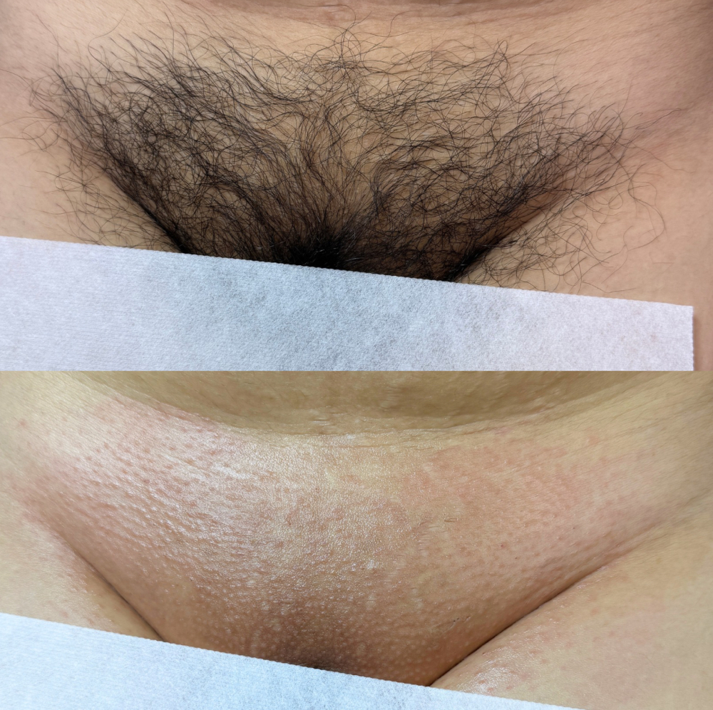 Brazilian at Classic Waxing Co in La Habra, CA