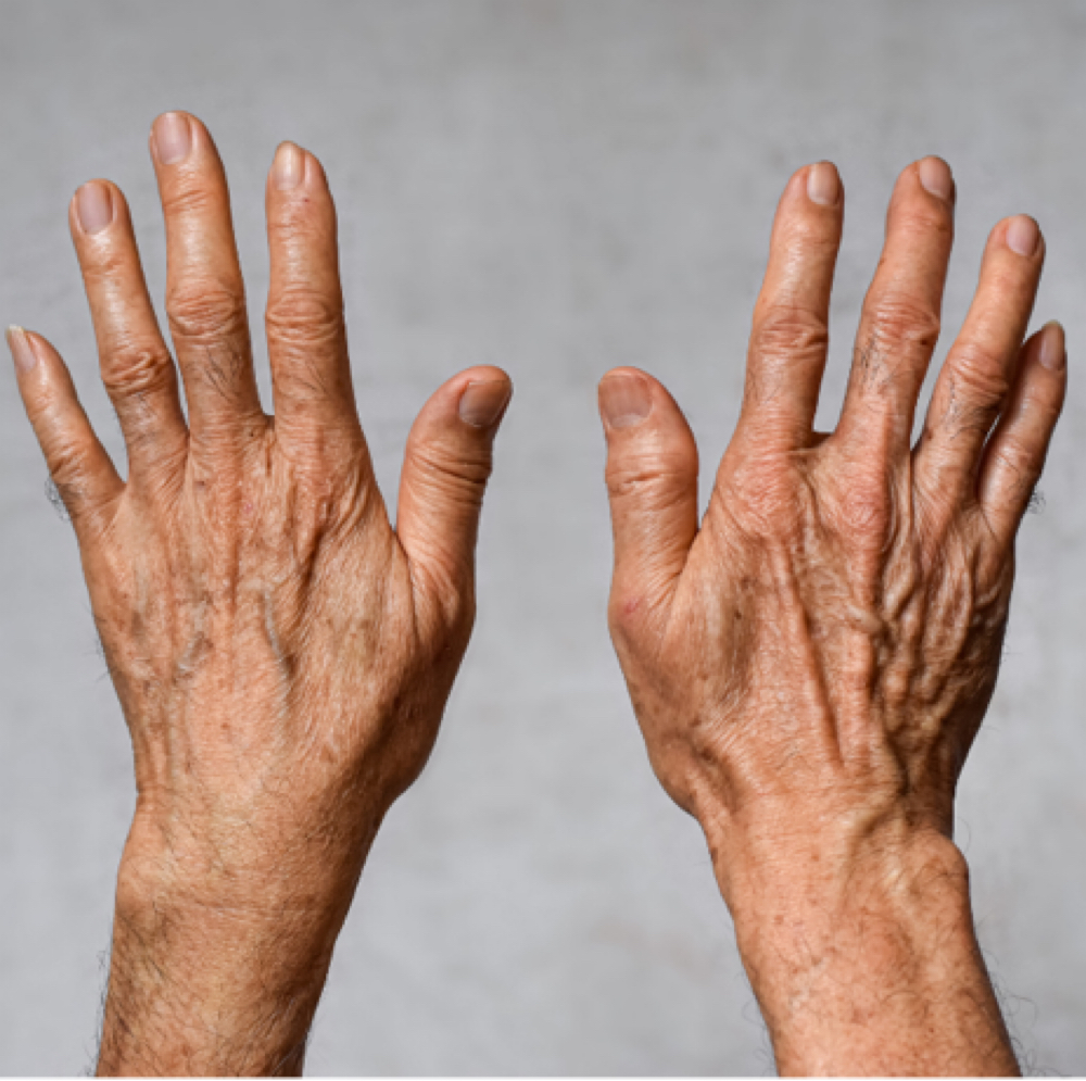 Rejuvenation & Pigment - Hands at Joy to Beauty in Jupiter, FL