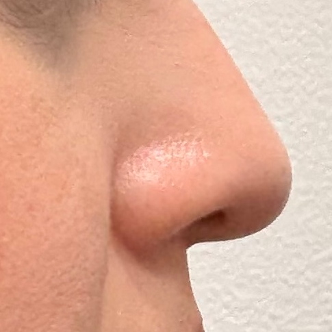 Tinker Nose at Radiant Aesthetics by Liz in El Paso, TX