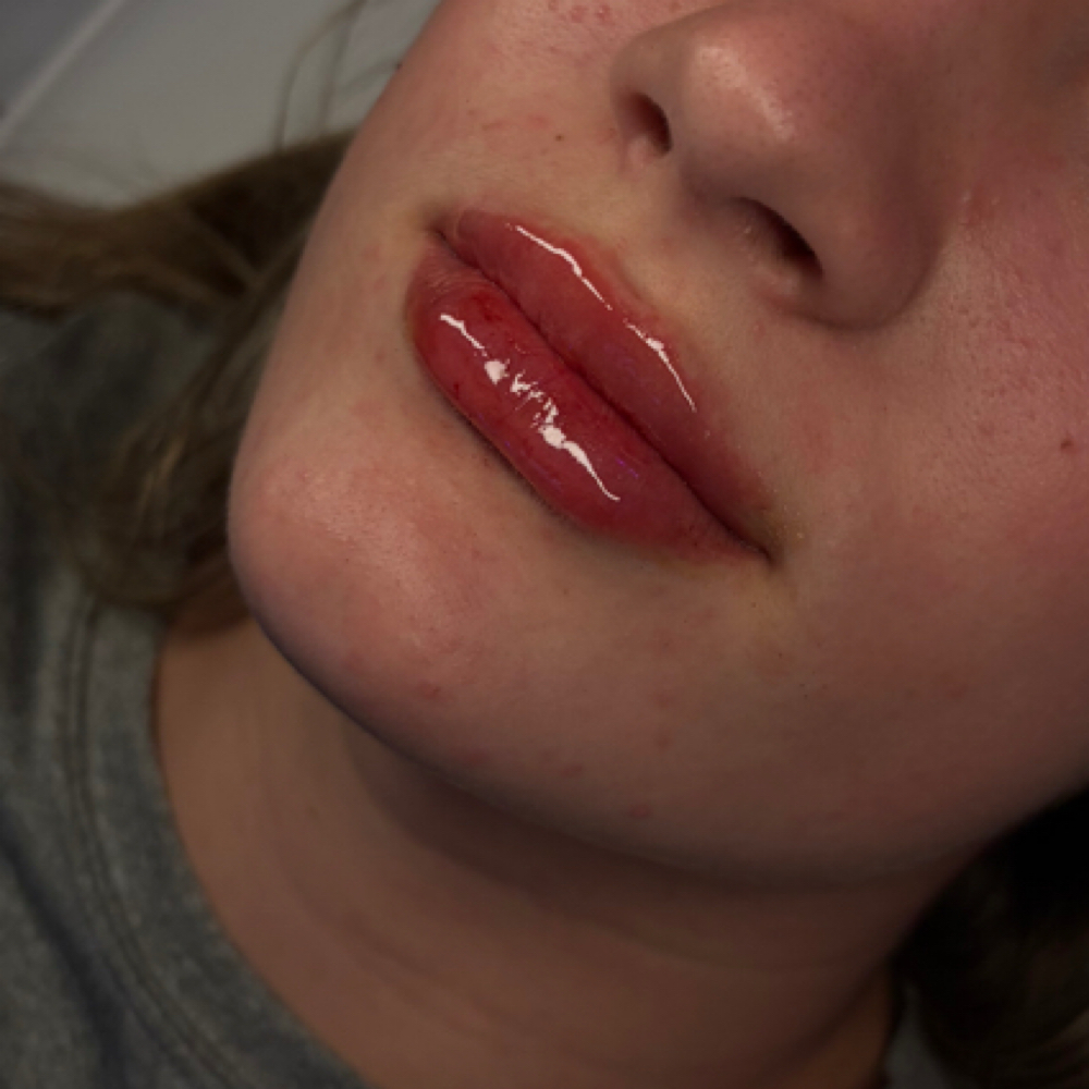 Lip Filler .5 mL at The Needle Studio Tx in Cleburne, TX