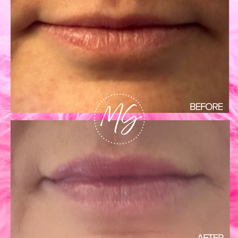 Lip Flip at Barnstar Aesthetics in Mocksville, NC