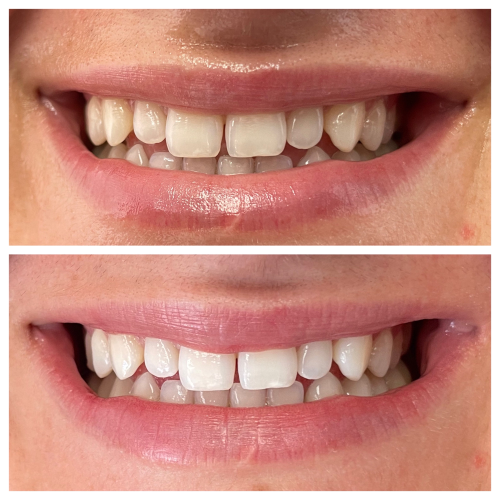 Teeth Whitening