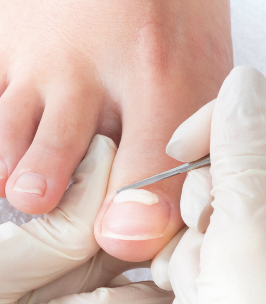 Onyfix full stripe at The Nail Room-Total Nail Care in Hartford, WI