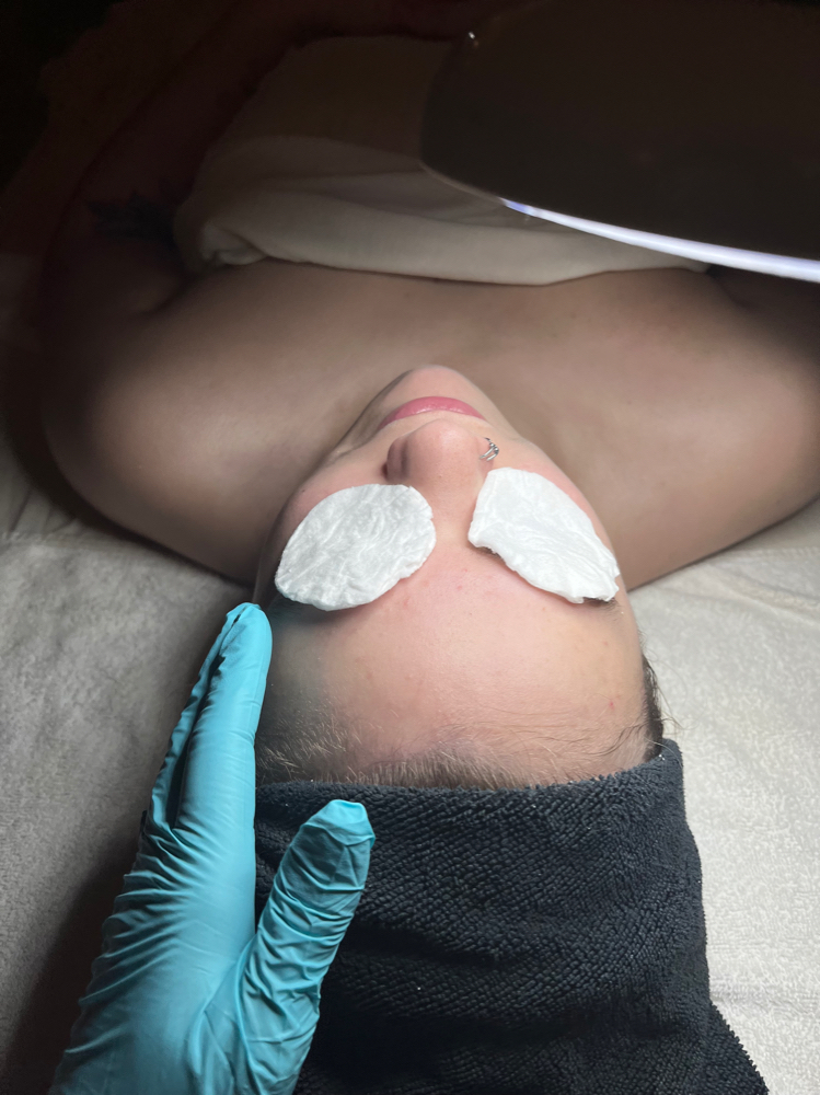 Acne Facial