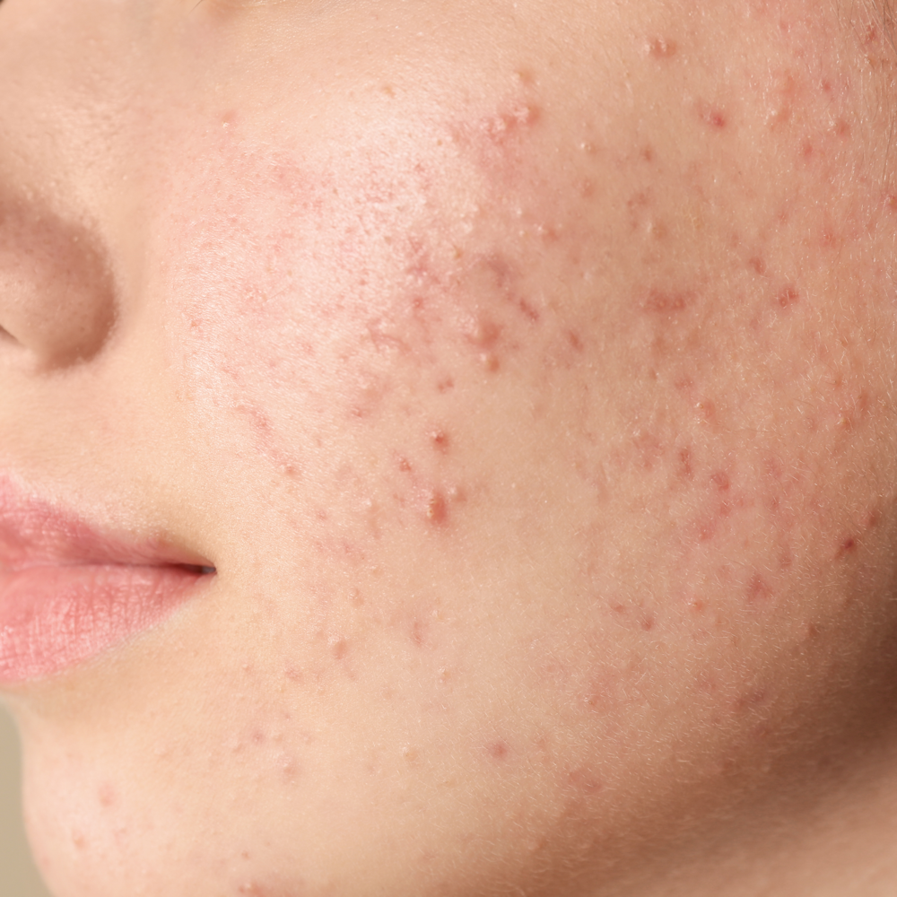 Acne Cleanse