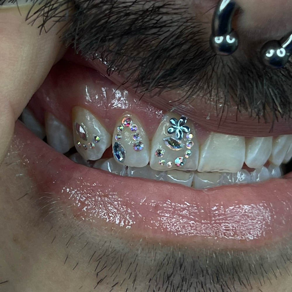 Moderate Freestyle (3-5 teeth)
