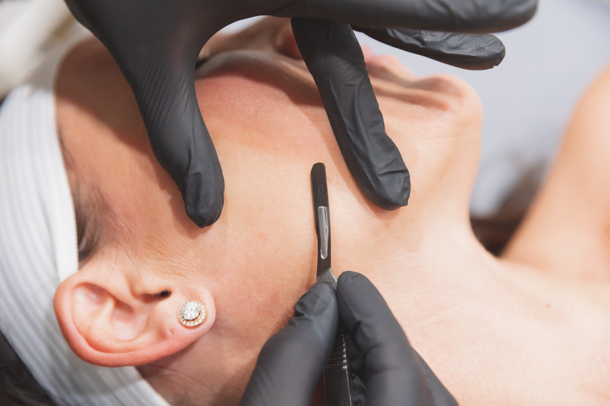 Dermaplaning