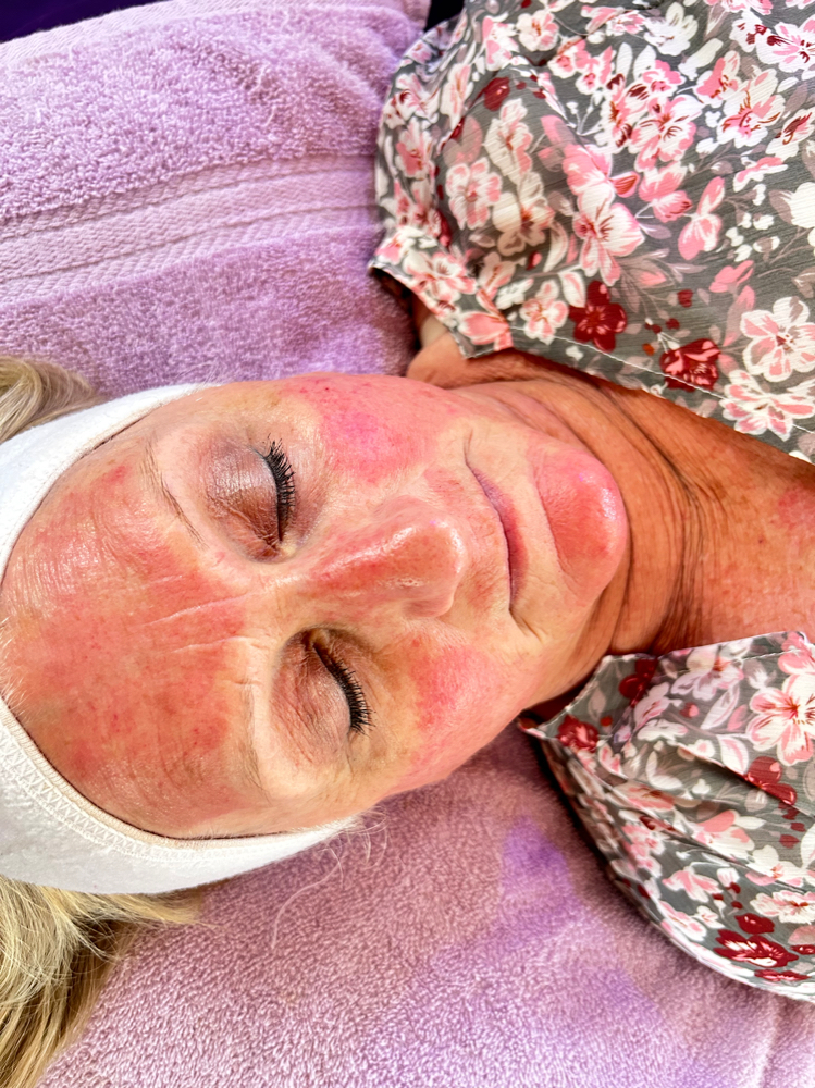 Micro-Facial