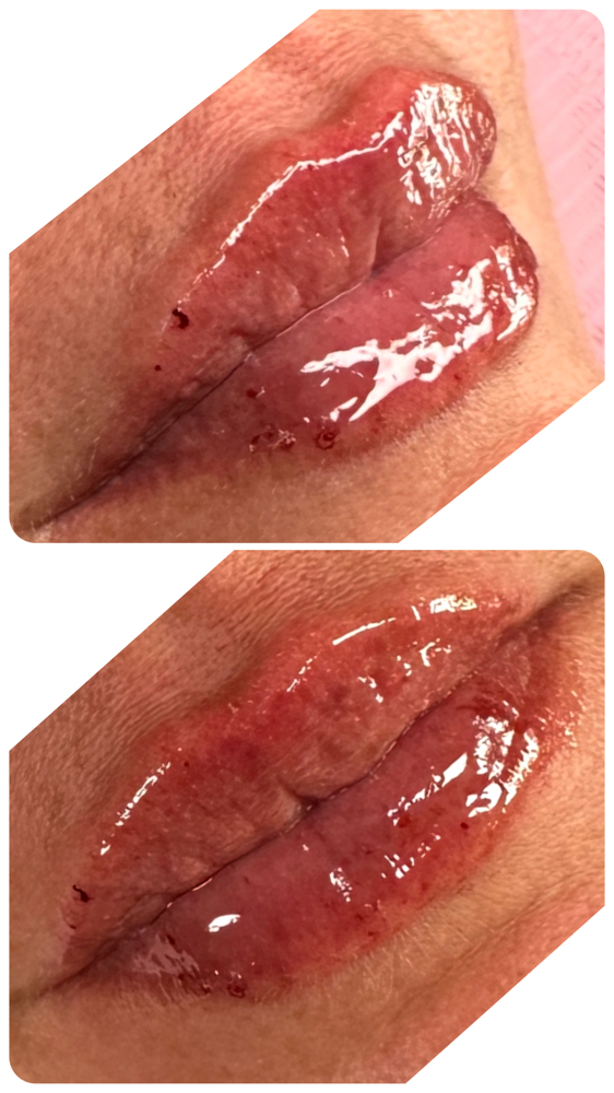 Micro-needling .05 ml