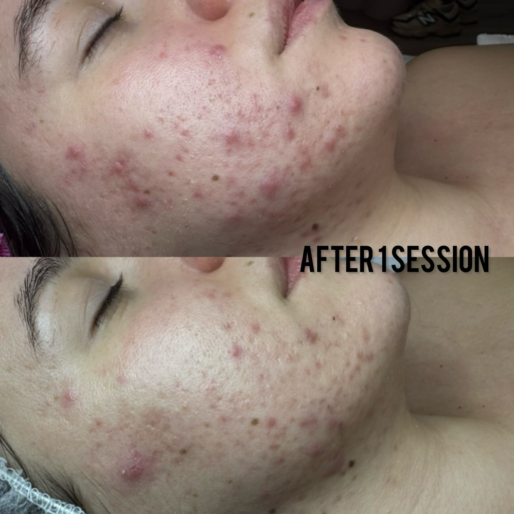 Acne Treatment at Healthy skin by Alvina in Highland Park, IL
