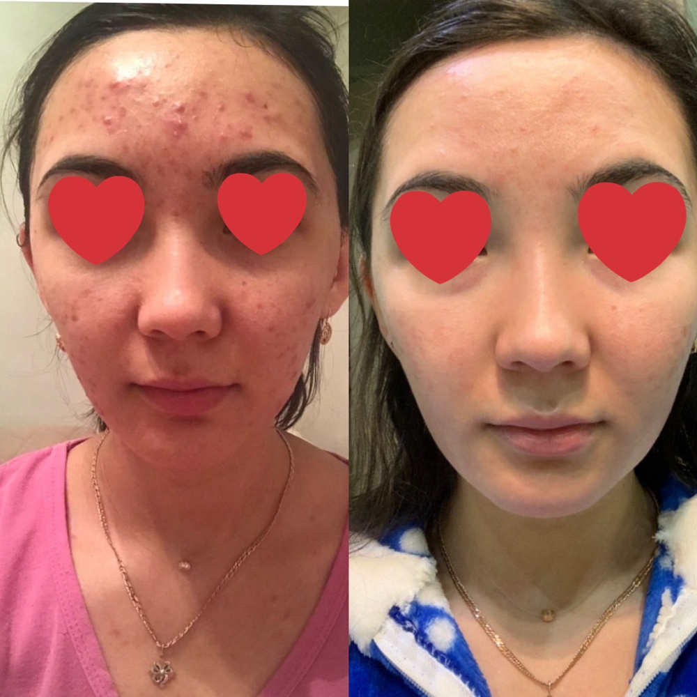 Clear Skin Treatment at Healthy skin by Alvina in Highland Park, IL