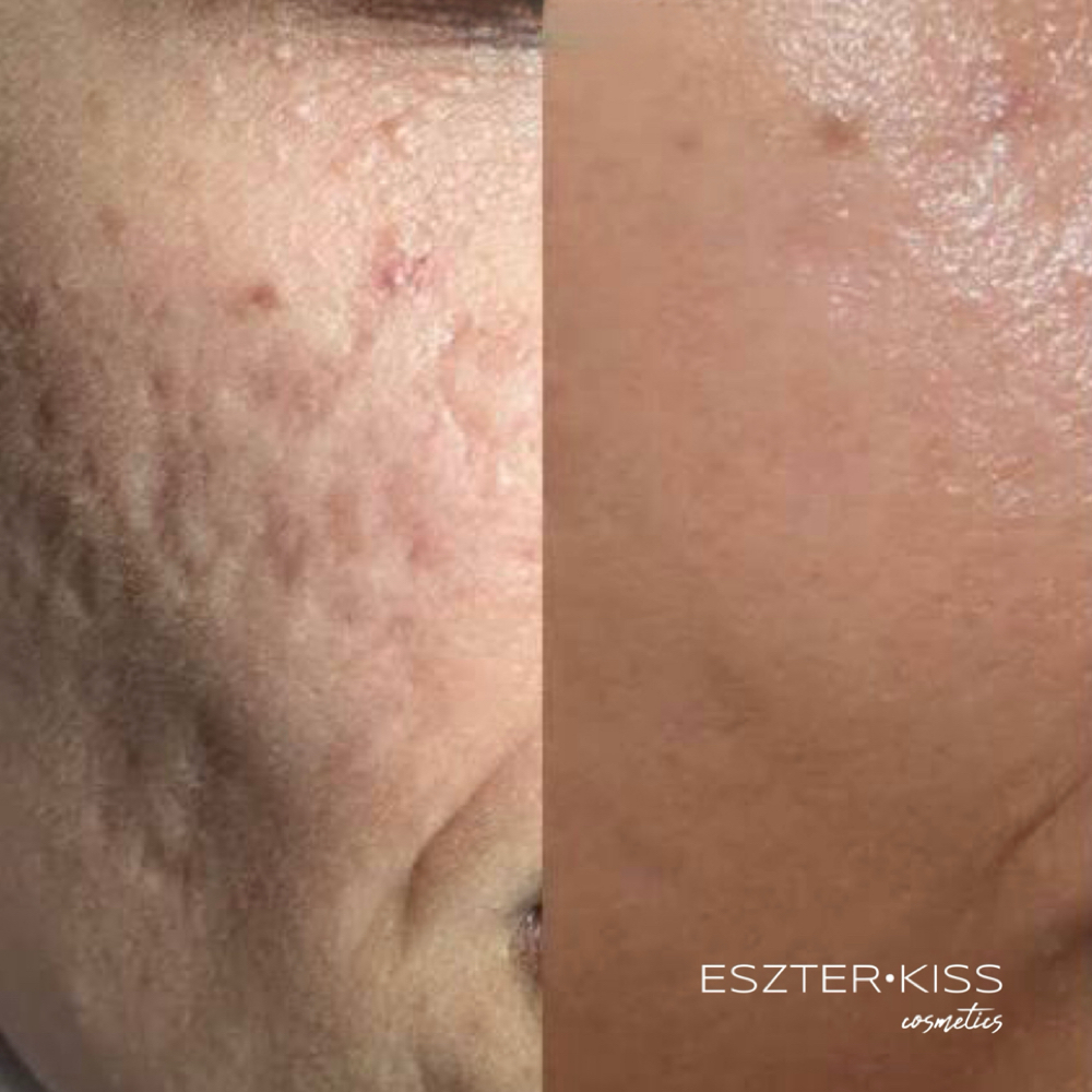 Acne Treatment-Plasma Fusion at Eszter Kiss Cosmetics in Deltona, FL