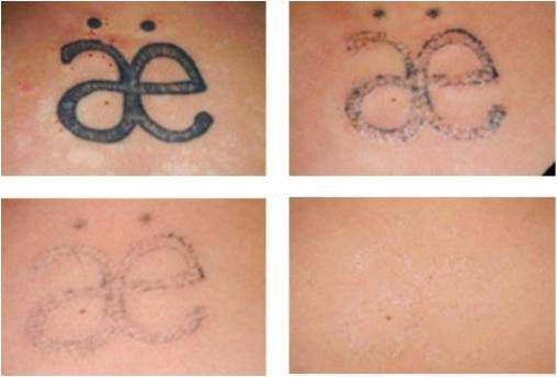 Tattoo Removal