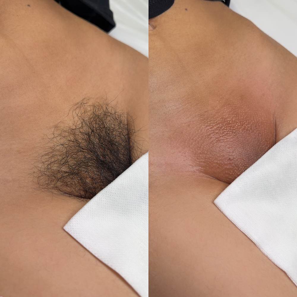 7 BRAZILIAN BUNDLE - $130 OFF !!! at INVU Beauty Salon in Modesto, CA