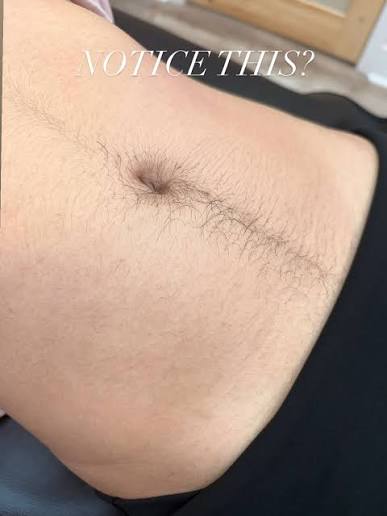 Stomach Strip at Shay’s Peaceful Escape, LLC in San Antonio, TX