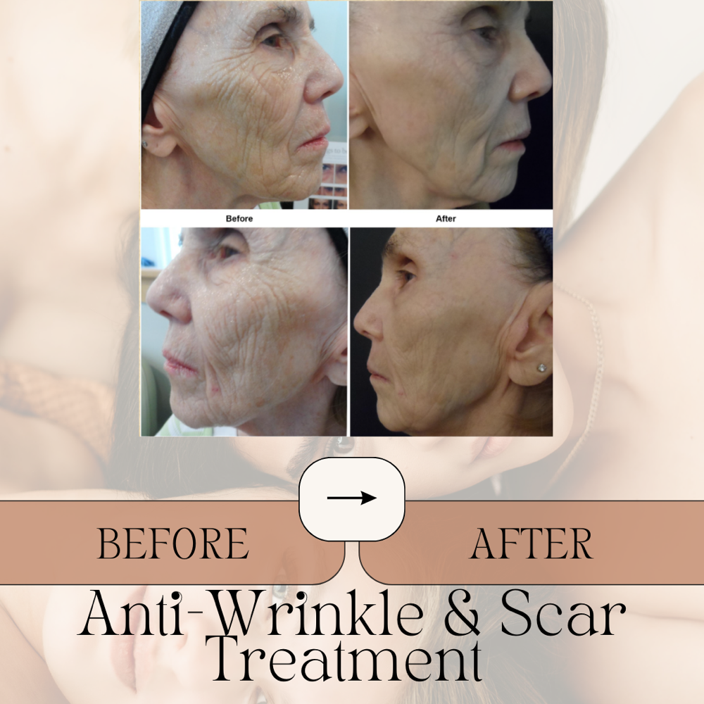 Face & Neck - Anti-Wrinkle /Scar TX