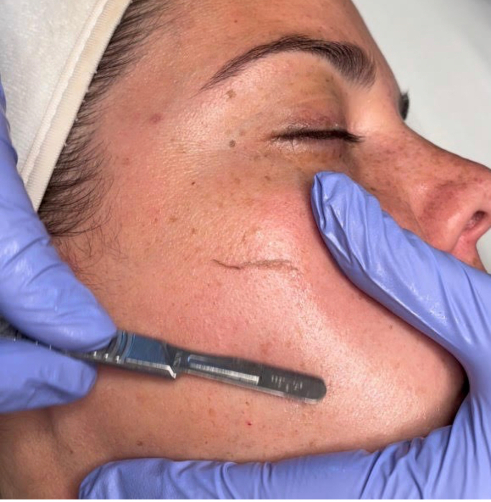 Dermaplane Facial