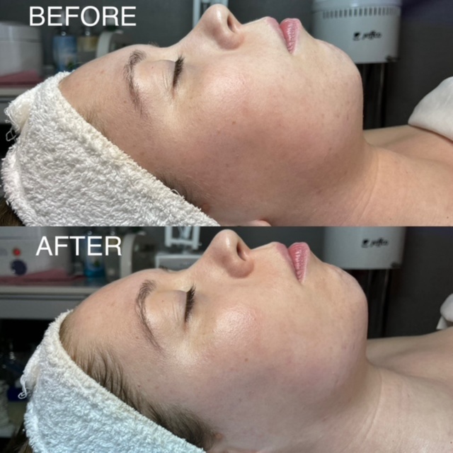 Nano-Infusion Resurfacing Facial at BK Skin & Brow Co. in Saint Charles, IL