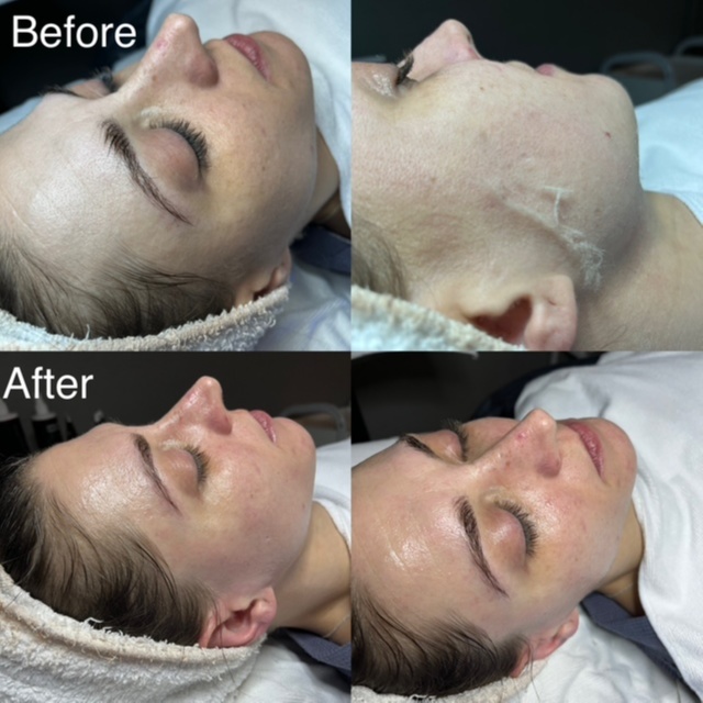 Radiance Dermaflash Facial 60 min at BK Skin & Brow Co. in Saint Charles, IL
