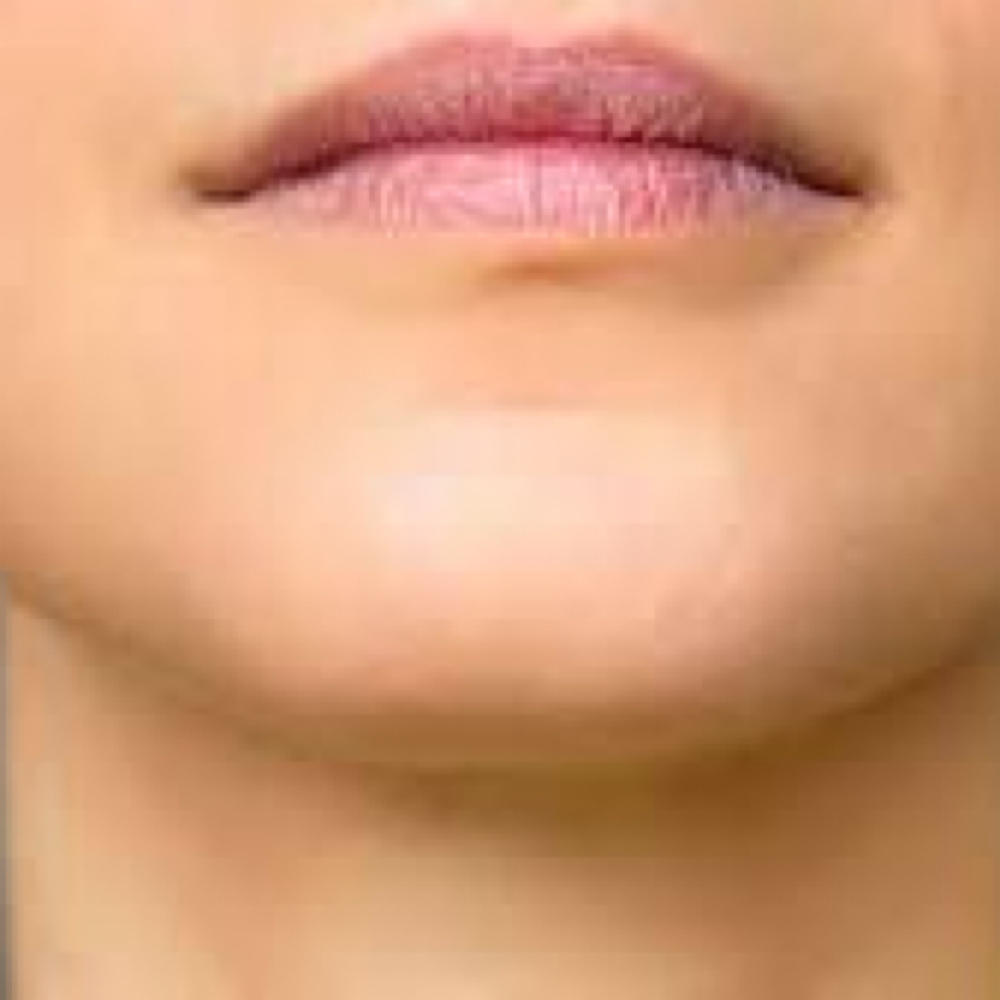 Chin Wax at The Soft Edit in Littleton, CO