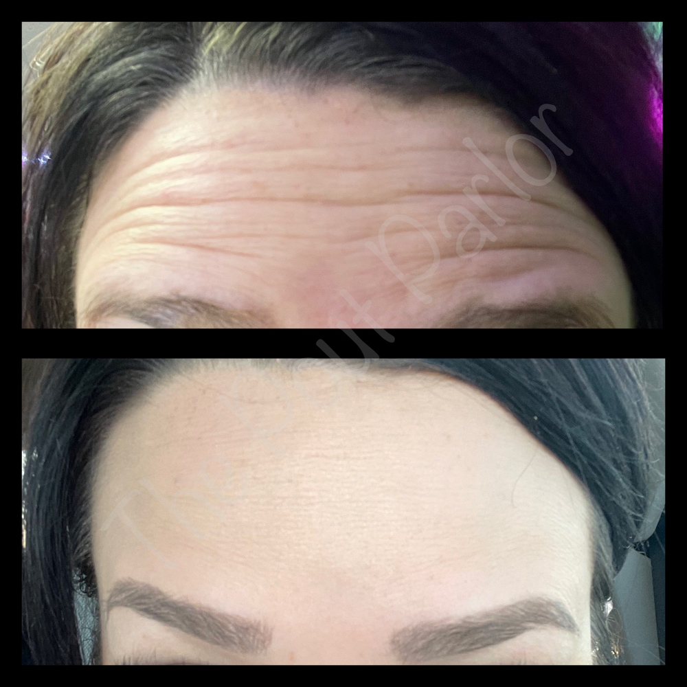 💕Botox