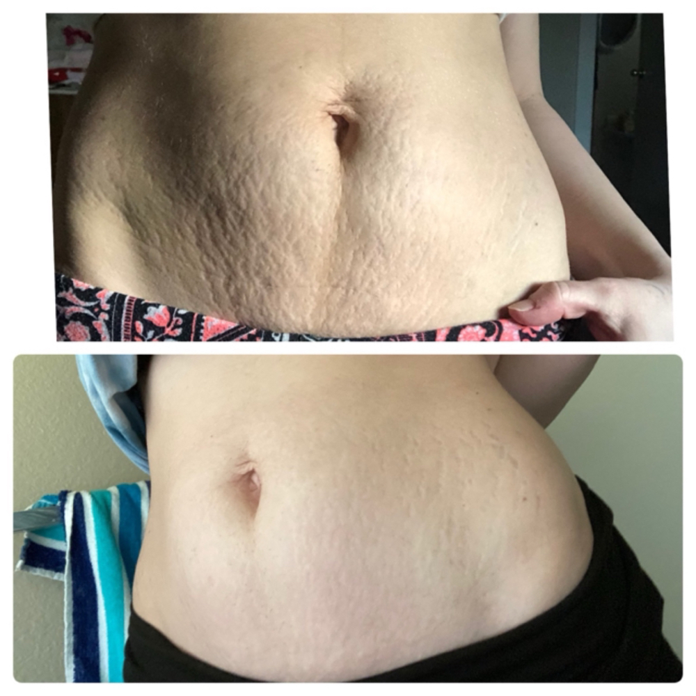 Stretch mark Inkless
