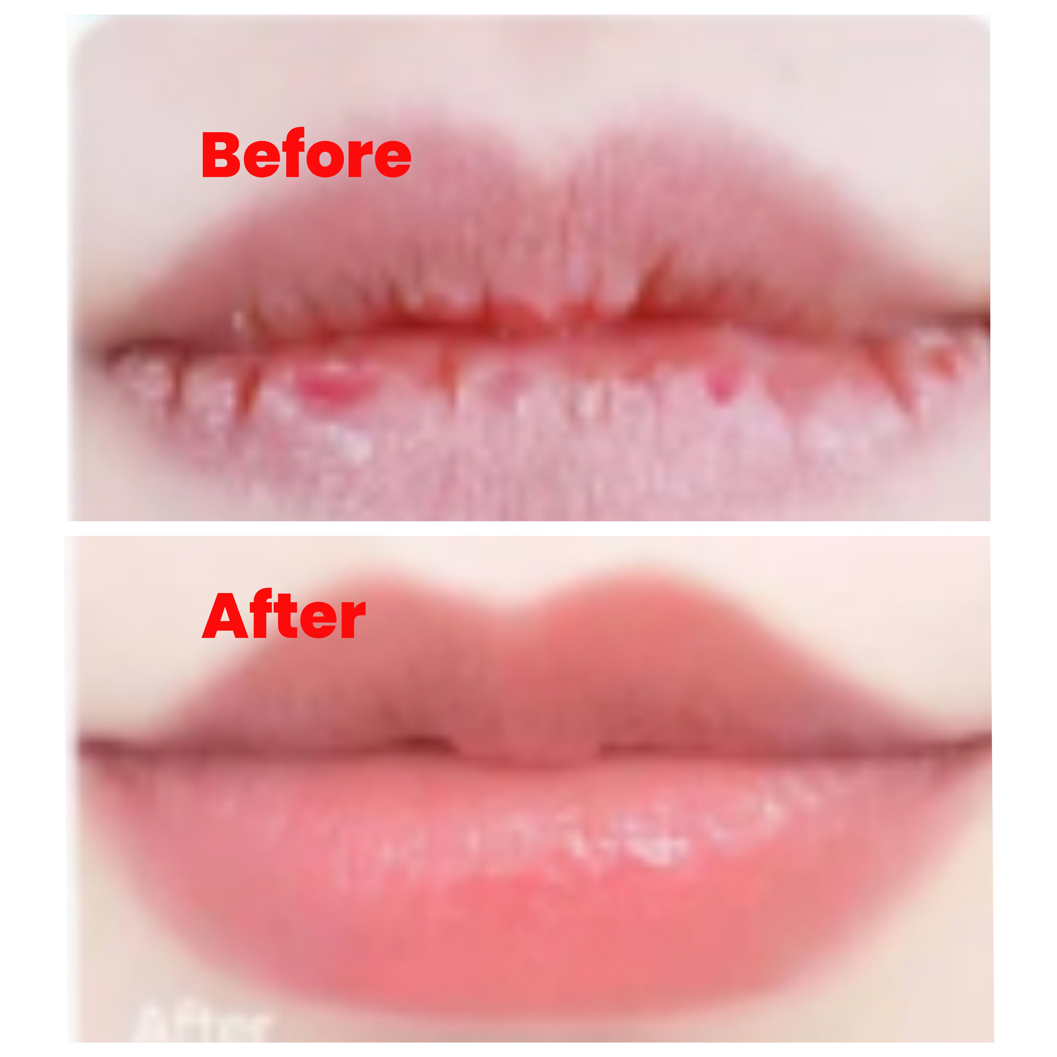 Hyaluronic Acid Lip treatment