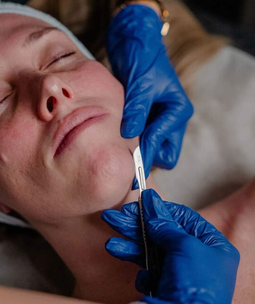 Dermaplane Facial