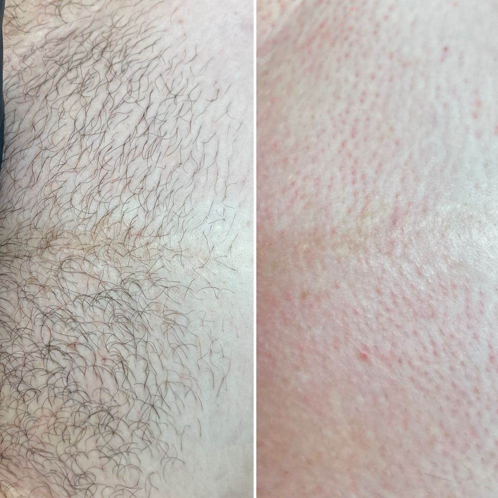 Brazilian Wax