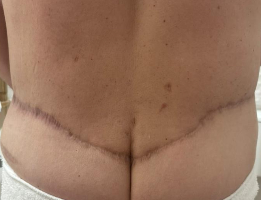 Inkless/Camo Tummy Tuck Scar 360