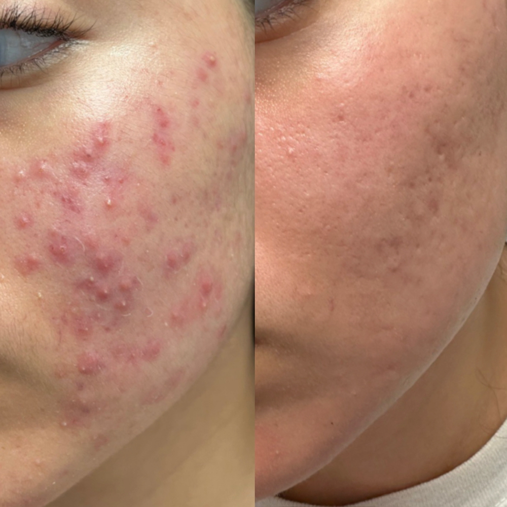 Acne Facial at Lumis MedSpa in Houston, TX