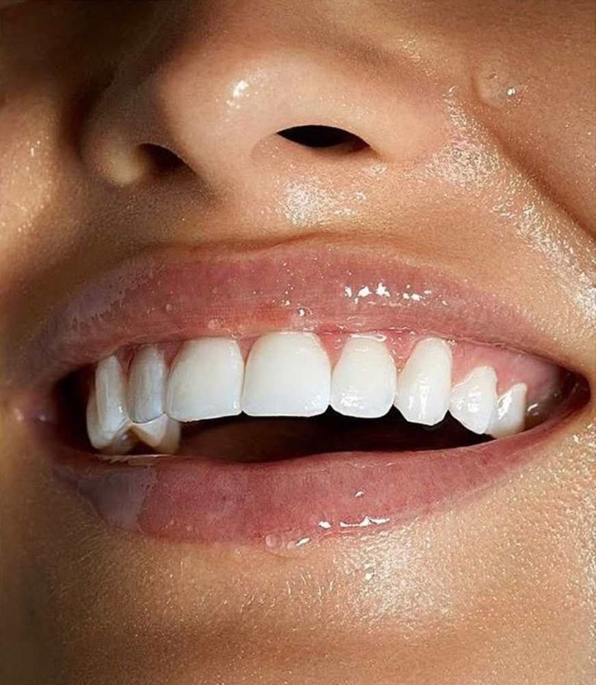 Basic Teeth Whitening