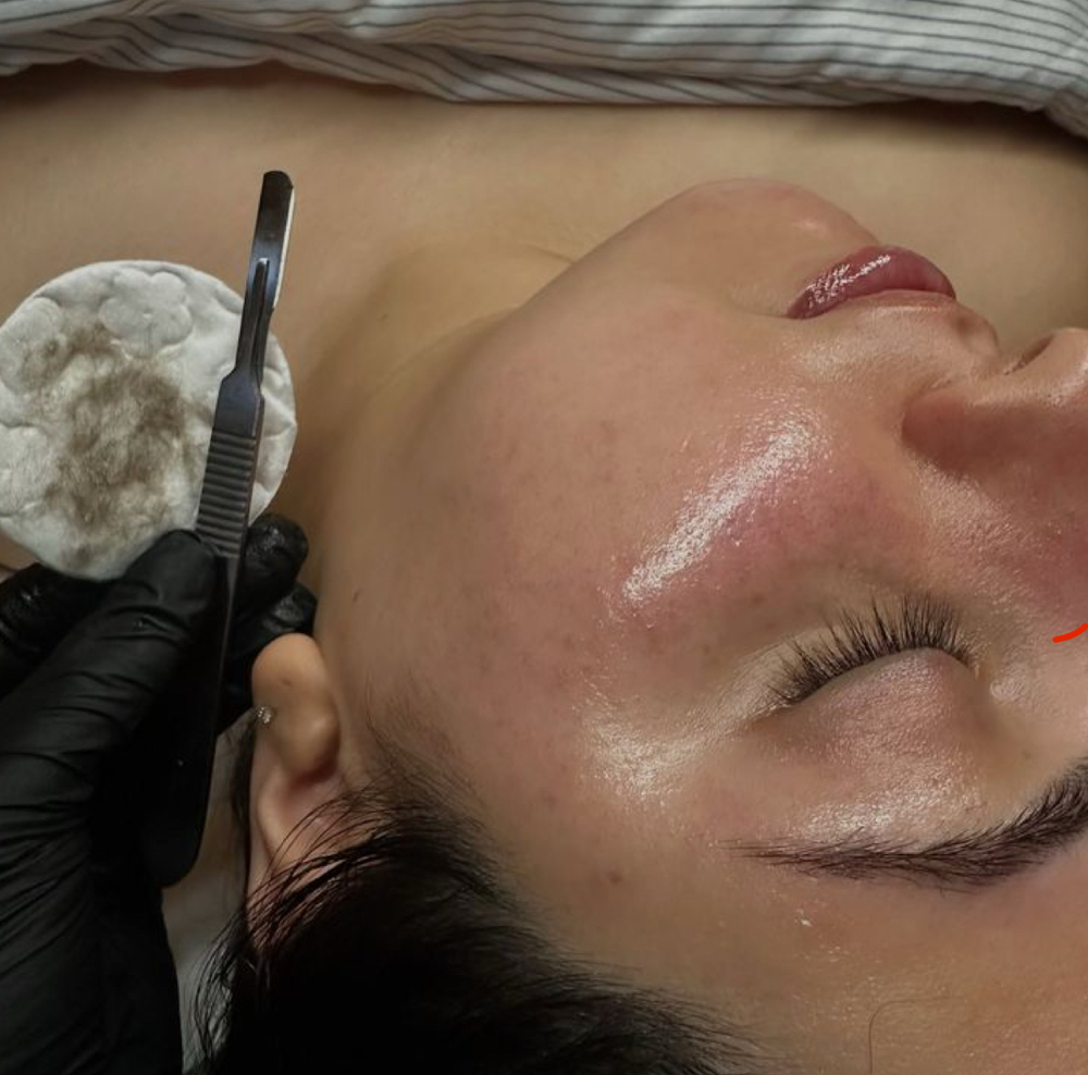 Dermaplaning Add-On