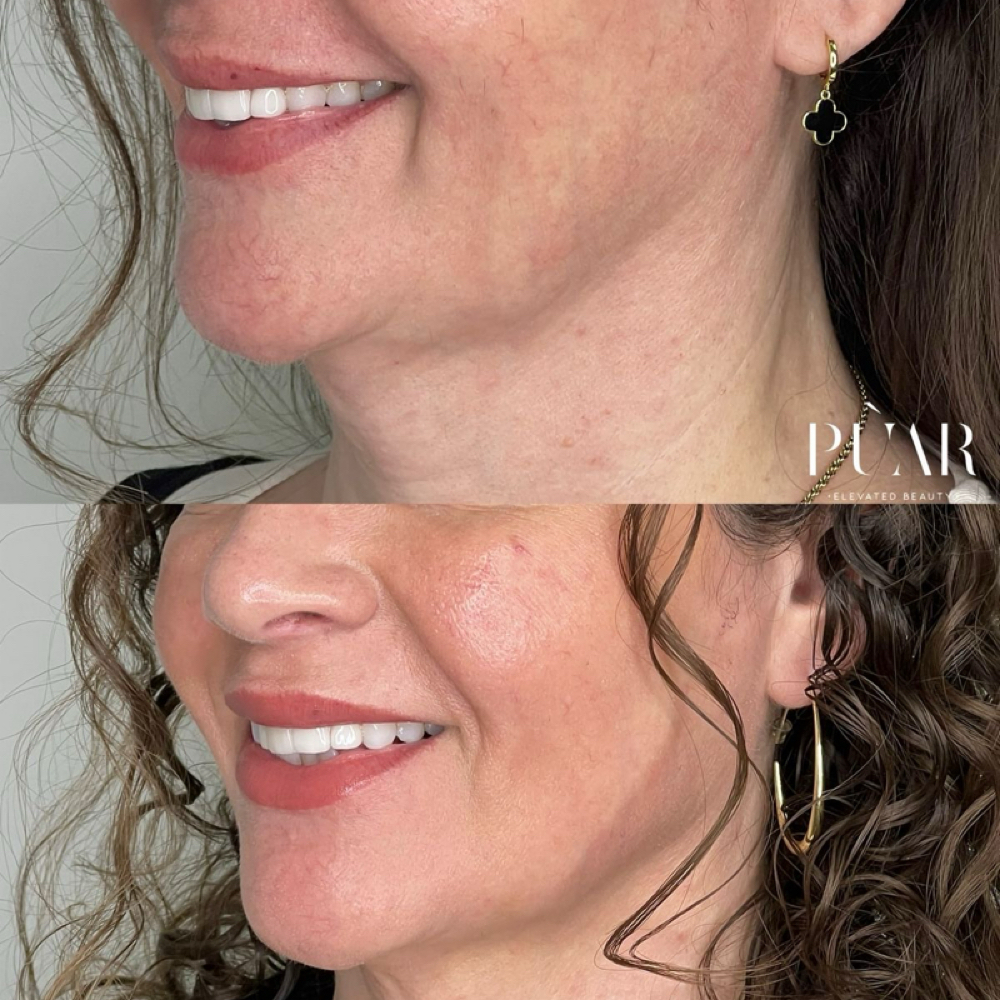 Nefertiti + Masseters at Kimspa&beauty in Dallas, TX