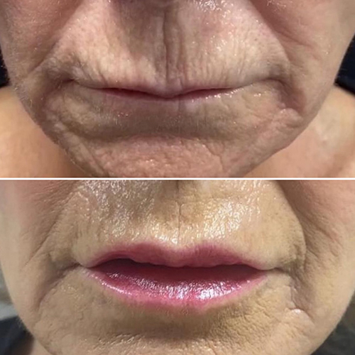Skin Tightening  Smile Lines