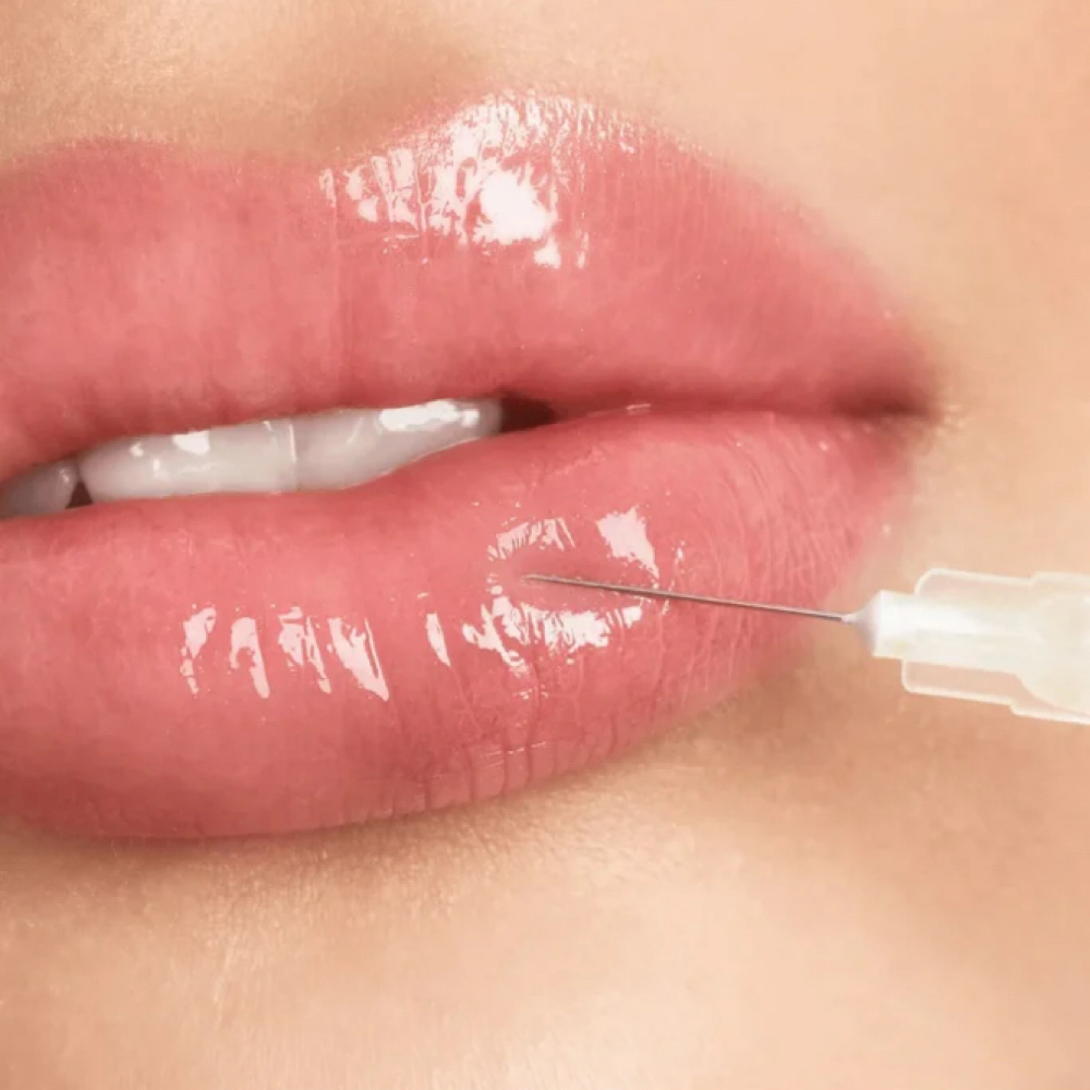 Lip Filler at Native Beauty in Garden City, MI