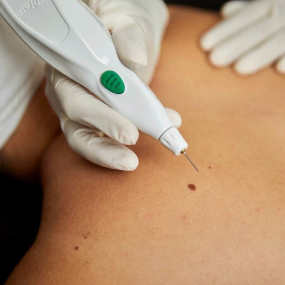 Mole Removal /sunspot Removal Plexr at R.D.M AESTHETICS in Bellmore, NY
