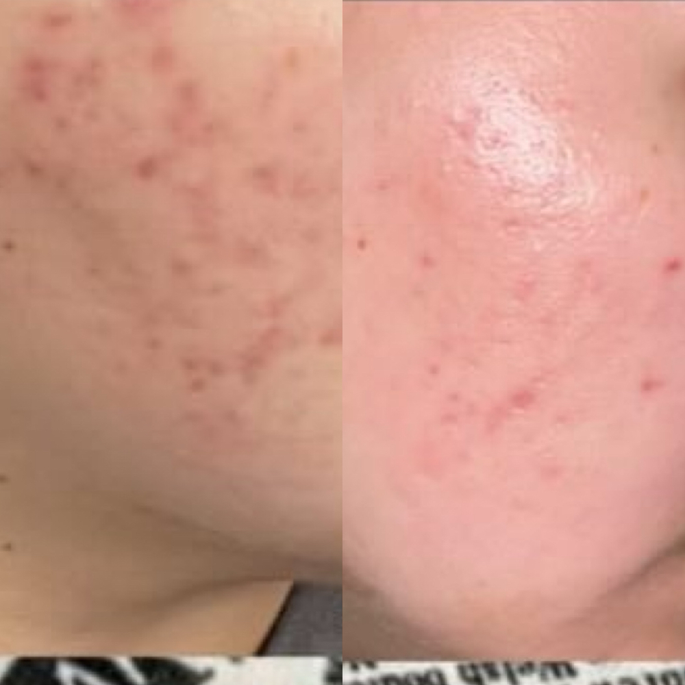 Acne Facial- Initial Visit at Salon Citrine in Indianapolis, IN