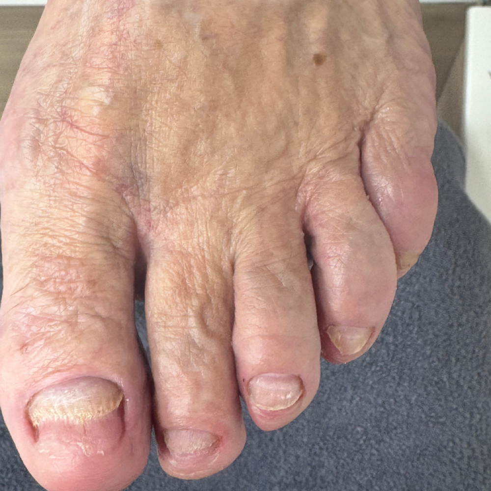 Fungal Debridement Pedicure at Southern Oregon PEDICURE CLINIC in Medford, OR