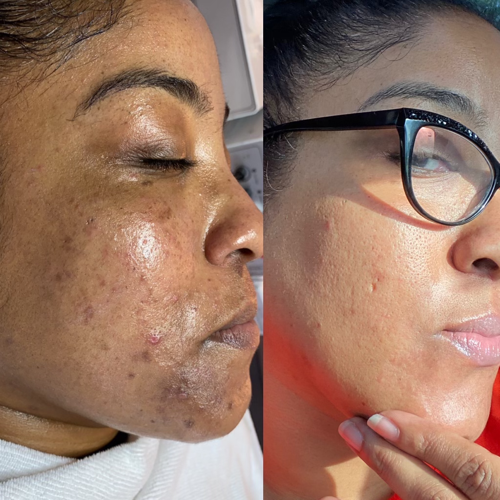 Microneedling Treatment