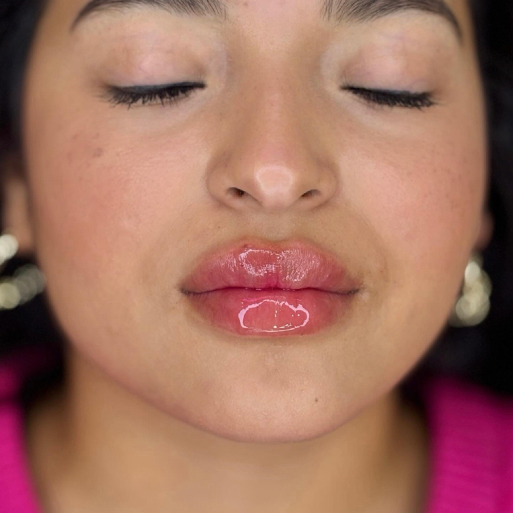 ✨MODEL PROMO LIP FILLER✨ at The Skin Room Med Spa in Marshall, TX