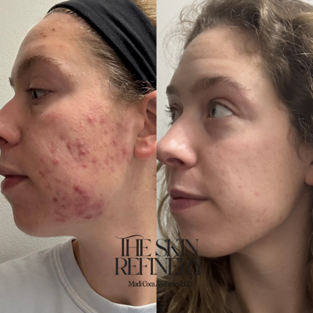 acne bootcamp treatment at Madi Coca Aesthetics At The Skin Refinery in Nicholasville, KY
