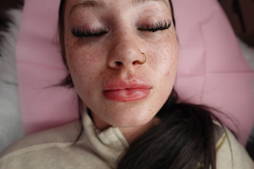 2ML (2 Full Synringe)MICRO-NEEDLING