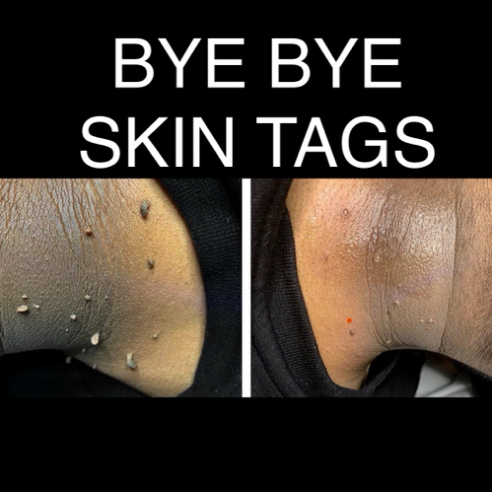 Bye Bye SkinTags with Plexr at Plump Haus LA in Beverly Hills, CA