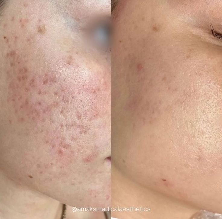 Acne Facial